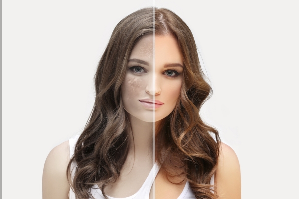 skin lightening treatment images 2